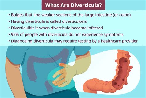 diverticulosis wikipedia|how many people have diverticulosis.